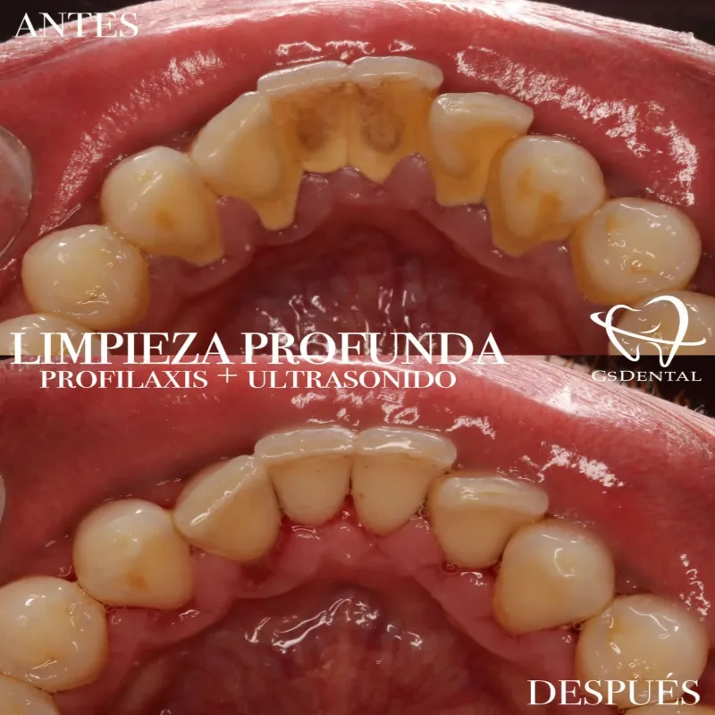 Limpieza Dental